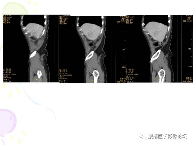 【病例】肝脏多发结核1例CT影像表现 【病例】肝脏多发结核1例CT影像表现