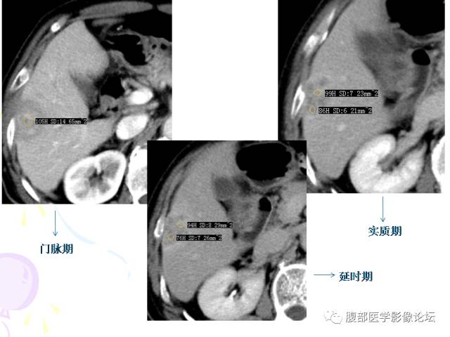 【病例】肝脏多发结核1例CT影像表现 【病例】肝脏多发结核1例CT影像表现