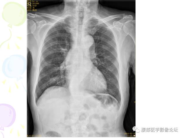 【病例】肝脏多发结核1例CT影像表现 【病例】肝脏多发结核1例CT影像表现