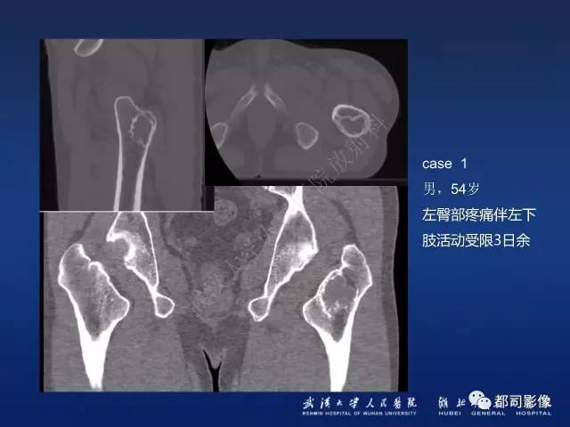 【PPT】骨原发性黄色瘤影像诊断