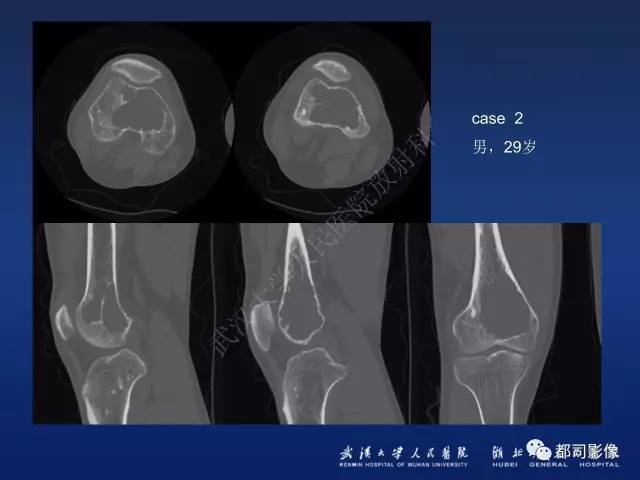 【PPT】骨原发性黄色瘤影像诊断