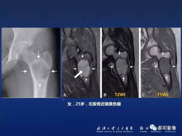【PPT】骨原发性黄色瘤影像诊断