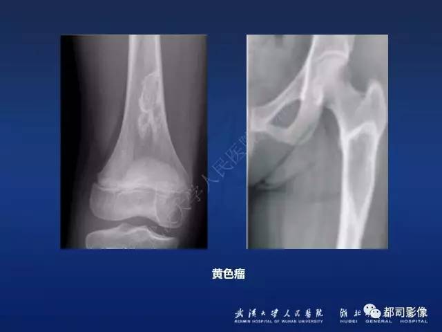 【PPT】骨原发性黄色瘤影像诊断