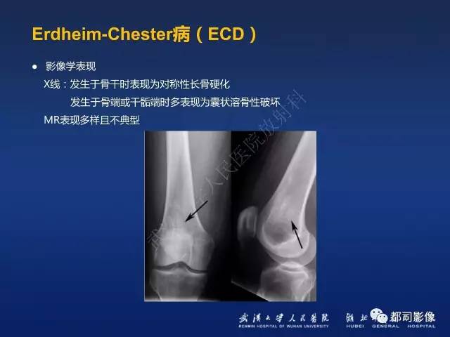 【PPT】骨原发性黄色瘤影像诊断