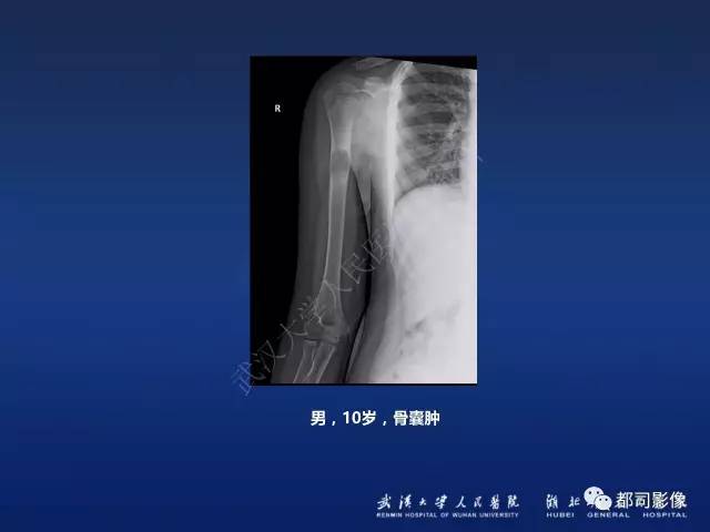 【PPT】骨原发性黄色瘤影像诊断