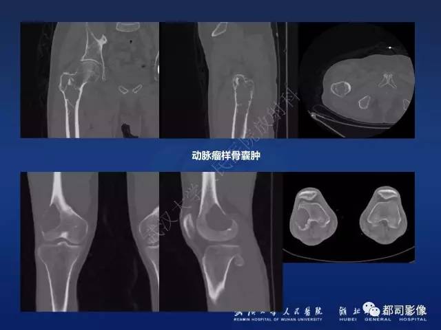 【PPT】骨原发性黄色瘤影像诊断