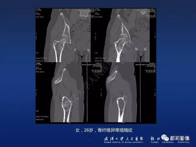 【PPT】骨原发性黄色瘤影像诊断