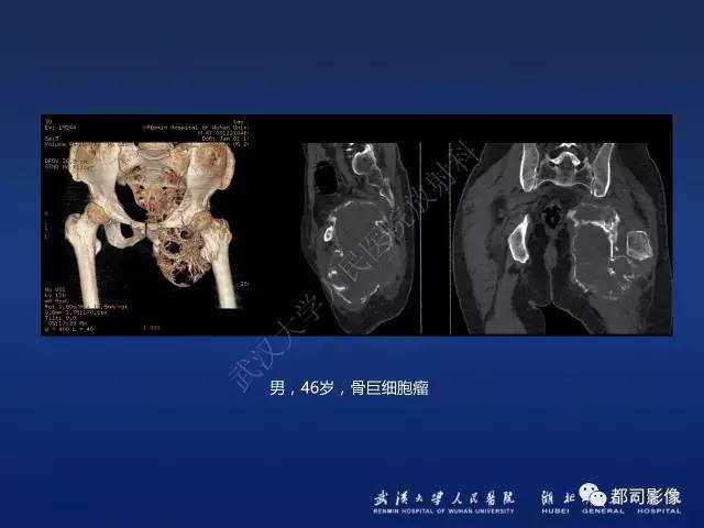【PPT】骨原发性黄色瘤影像诊断