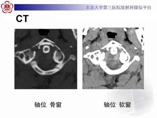 【病例】寰椎爆裂性骨折1例CT及MR
