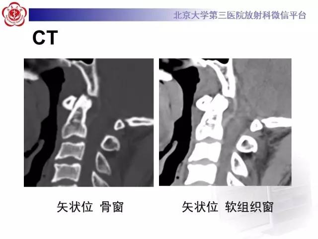 【病例】寰椎爆裂性骨折1例CT及MR