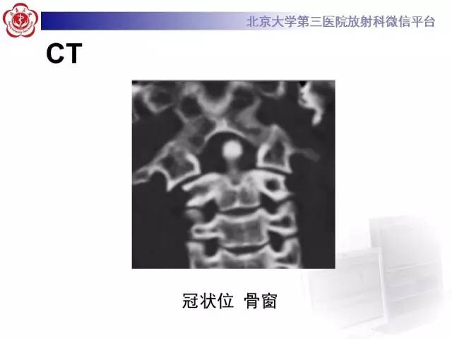 【病例】寰椎爆裂性骨折1例CT及MR