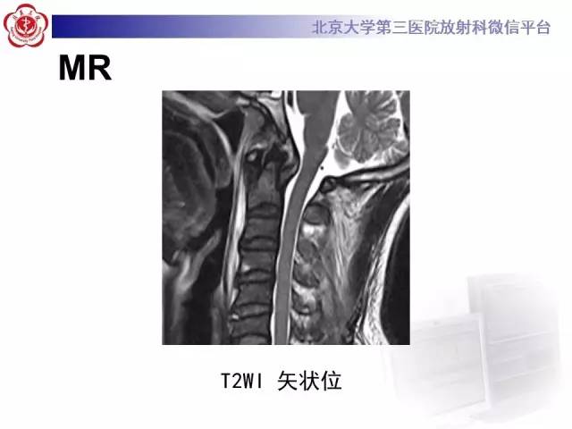 【病例】寰椎爆裂性骨折1例CT及MR