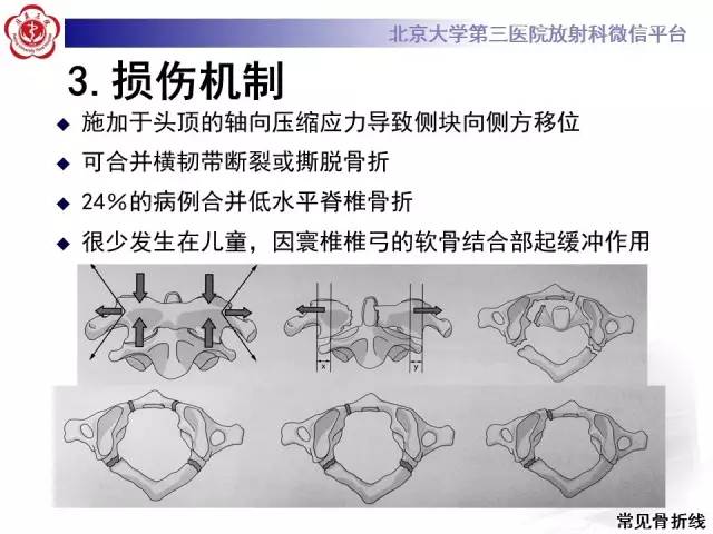 【病例】寰椎爆裂性骨折1例CT及MR