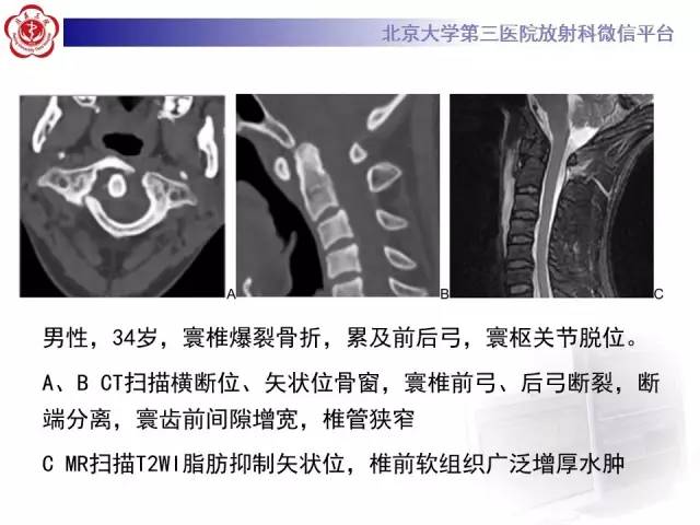 【病例】寰椎爆裂性骨折1例CT及MR