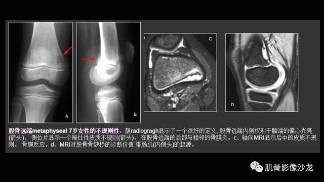 【PPT】年轻人膝关节的几个疾病