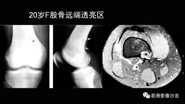 【PPT】年轻人膝关节的几个疾病