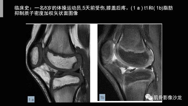 【PPT】年轻人膝关节的几个疾病