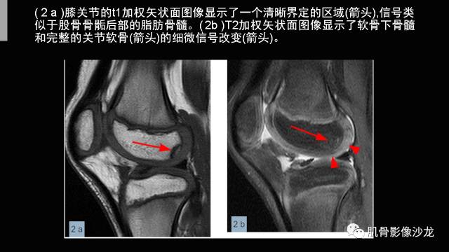 【PPT】年轻人膝关节的几个疾病