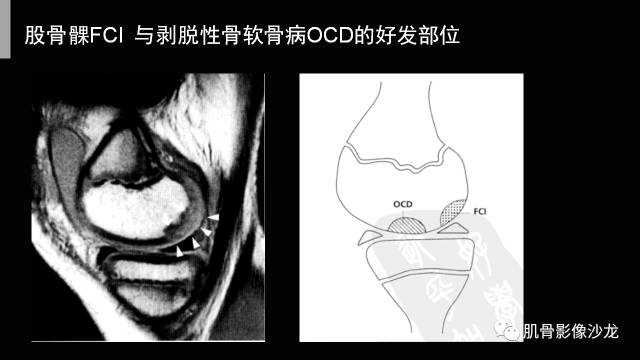 【PPT】年轻人膝关节的几个疾病