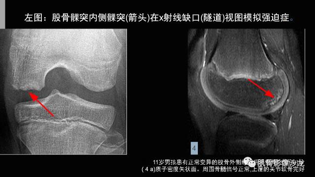 【PPT】年轻人膝关节的几个疾病