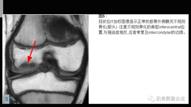 【PPT】年轻人膝关节的几个疾病