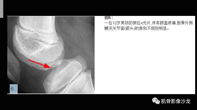 【PPT】年轻人膝关节的几个疾病