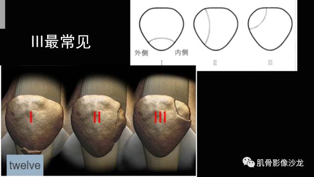 【PPT】年轻人膝关节的几个疾病