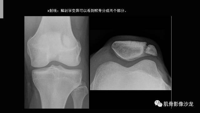 【PPT】年轻人膝关节的几个疾病