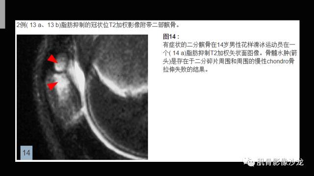【PPT】年轻人膝关节的几个疾病