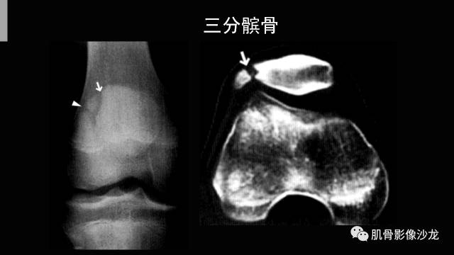 【PPT】年轻人膝关节的几个疾病