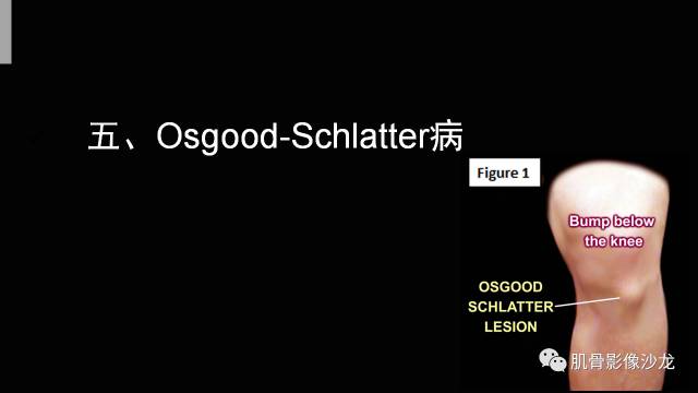 【PPT】年轻人膝关节的几个疾病