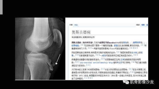 【PPT】年轻人膝关节的几个疾病