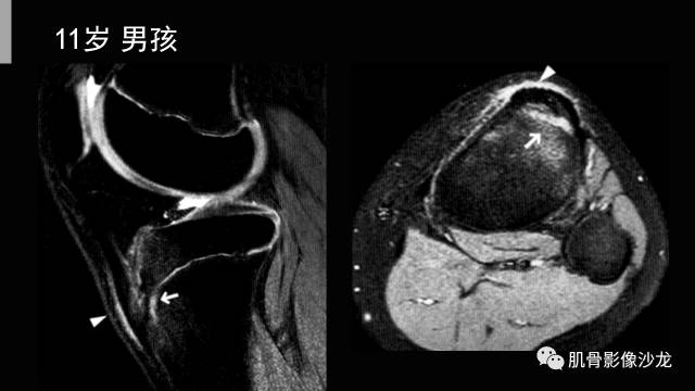 【PPT】年轻人膝关节的几个疾病