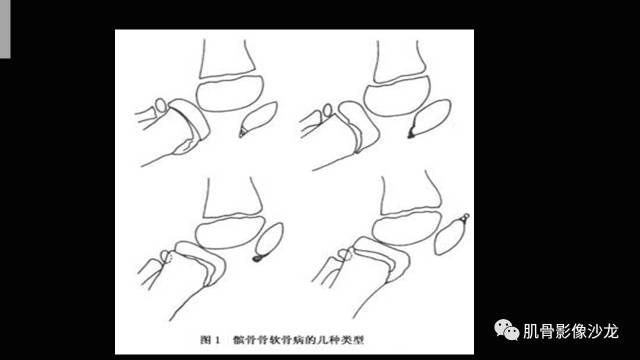 【PPT】年轻人膝关节的几个疾病