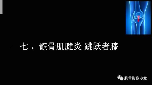 【PPT】年轻人膝关节的几个疾病