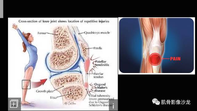 【PPT】年轻人膝关节的几个疾病