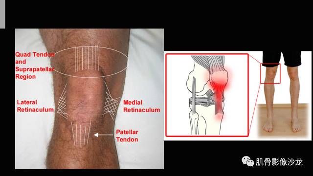 【PPT】年轻人膝关节的几个疾病