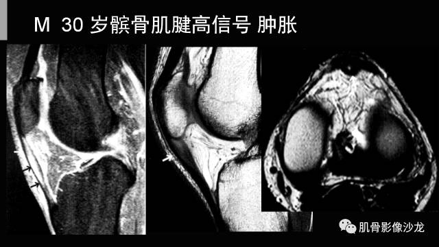 【PPT】年轻人膝关节的几个疾病