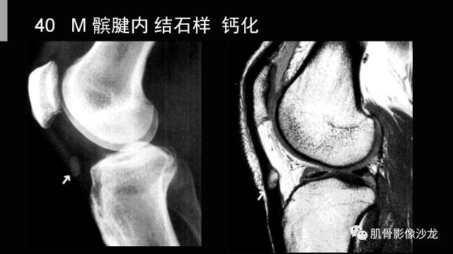 【PPT】年轻人膝关节的几个疾病