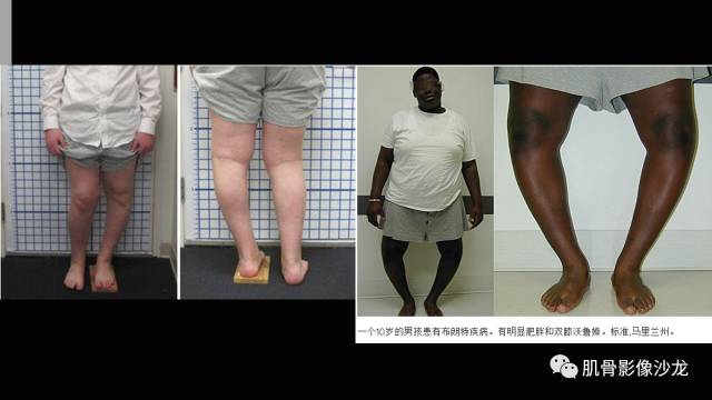 【PPT】年轻人膝关节的几个疾病