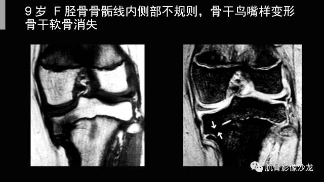 【PPT】年轻人膝关节的几个疾病