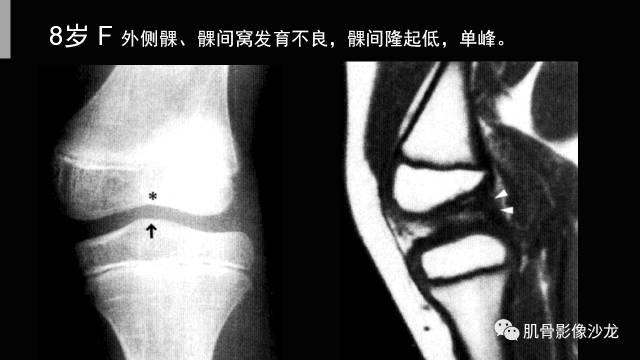 【PPT】年轻人膝关节的几个疾病