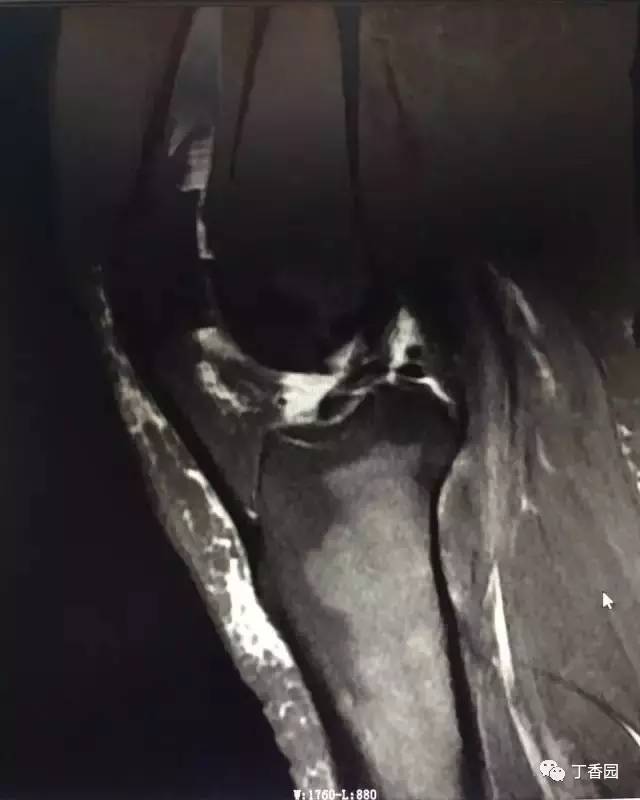 【病例】膝关节红骨髓转换1例MR