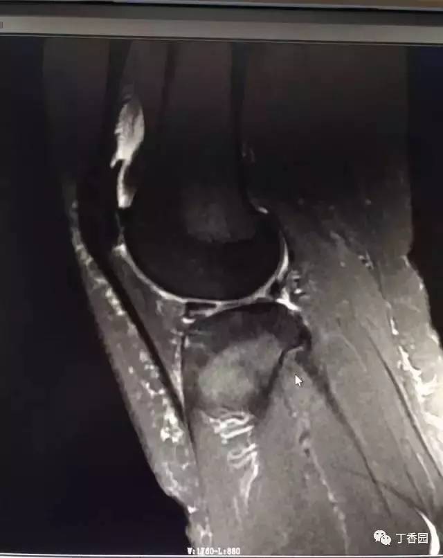 【病例】膝关节红骨髓转换1例MR