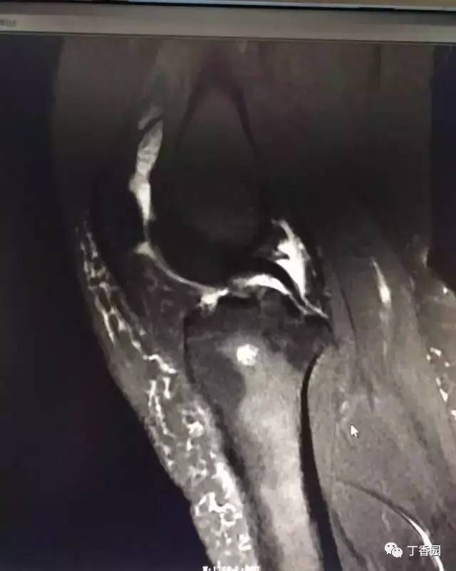 【病例】膝关节红骨髓转换1例MR