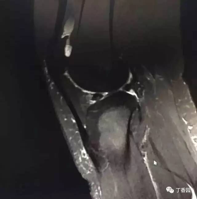 【病例】膝关节红骨髓转换1例MR