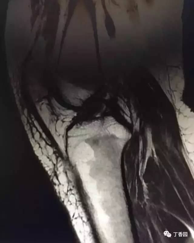 【病例】膝关节红骨髓转换1例MR