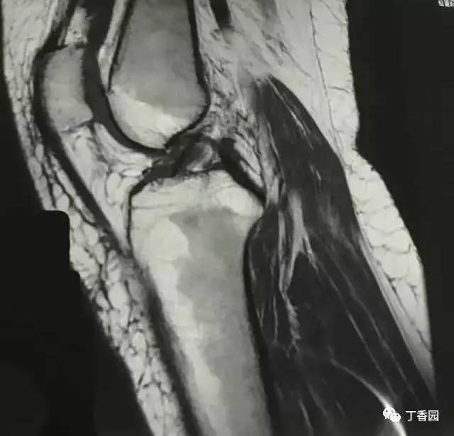 【病例】膝关节红骨髓转换1例MR