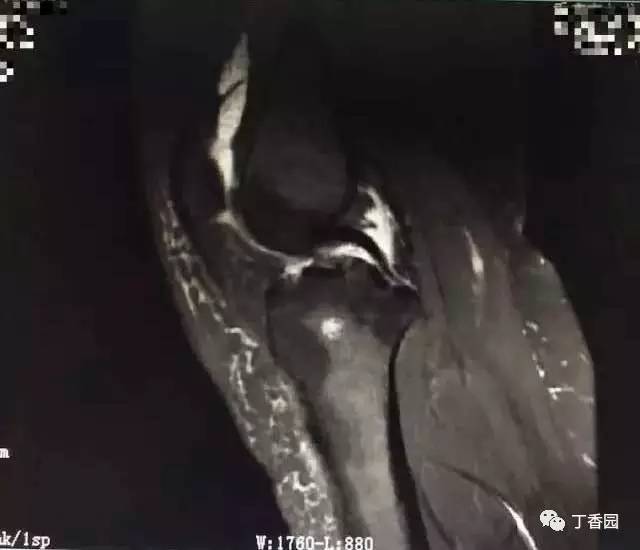 【病例】膝关节红骨髓转换1例MR