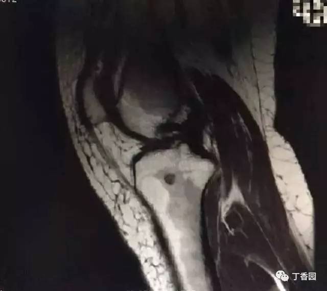 【病例】膝关节红骨髓转换1例MR
